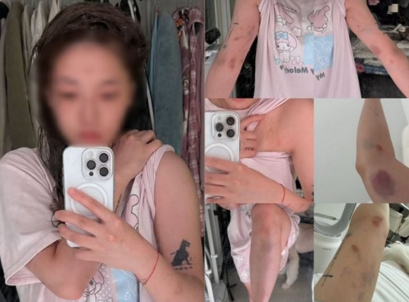 서울 홍대 거리를 걷다 폭행을 당했다고 주장한 대만 국적의 여성 유튜버 리잉 유(26)가 가해자가 한국인이라고 재차 이야기했다. 사진은 폭행 증거. [사진=A씨 SNS 갈무리]