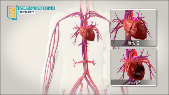 심혈관질환을 유발하는 원인은 명확하다. 고혈압, 당뇨병, 고지혈증, 흡연, 비만, 스트레스 등이 있다. [사진=EBS]