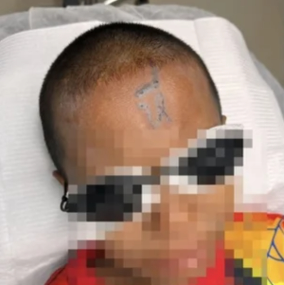 태국에서 10살 초등학생이 같은 반 친구들에게 강제로 외설적인 단어와 그림이 새겨진 '이마 타투'를 당하는 학교 폭력이 일어나 충격을 주고 있다. 사진은 피해 아동. [사진=X 갈무리 ]