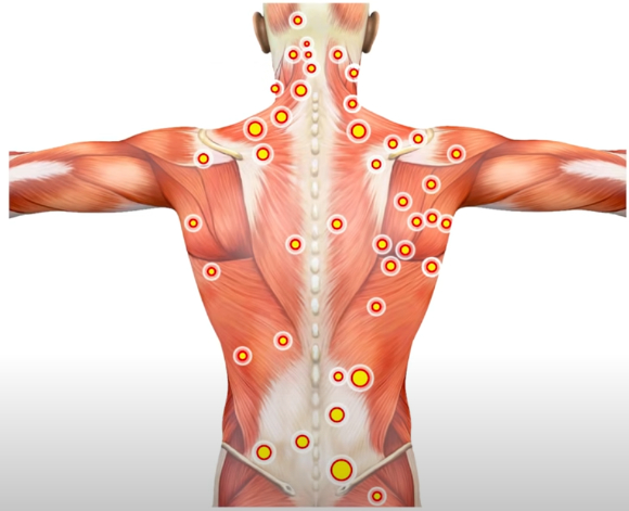 근막이 뭉쳐 통증이 발생하는 지점을 '트리거 포인트'라고 부른다. [사진=유튜브 채널 '세계적으로 유명한 운동 정보']