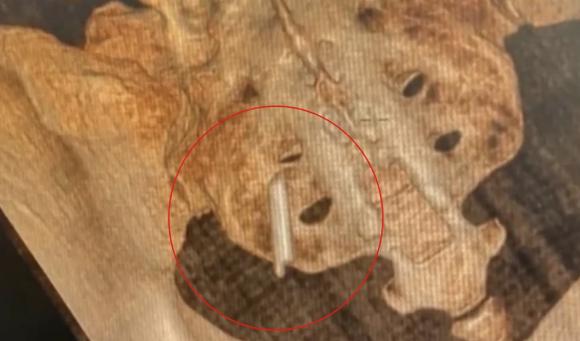 중국 후베이성 우한에 사는 한 여성의 몸속에서 22년 전 박힌 체온계 조각이 뒤늦게 발견돼 이목을 끌고 있다. 사진은 본 기사 내용과 무관. [사진=laketown-naishikyo]