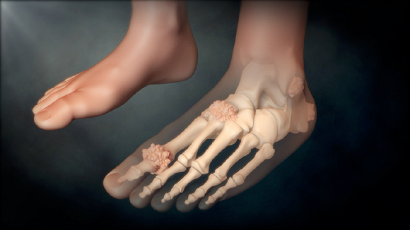 바람만 스쳐도 아픈 통풍, 통증의 왕이라고도 불린다. [사진=EBS]