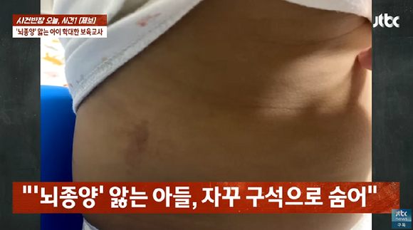 인천의 한 어린이집에서 뇌종양을 앓는 3살 아이가 어린이집 보육교사로부터 상습 폭행을 당했다는 주장이 나와 논란이 되고 있다. 사진은 3살 아이의 몸에서 발견된 폭행 자국. [사진=유튜브 채널 'JTBC News']