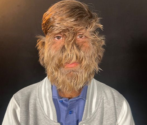 인도의 한 소년이 세계에서 얼굴 털이 가장 많은 사람으로 기네스북에 올랐다. [사진=기네스북]