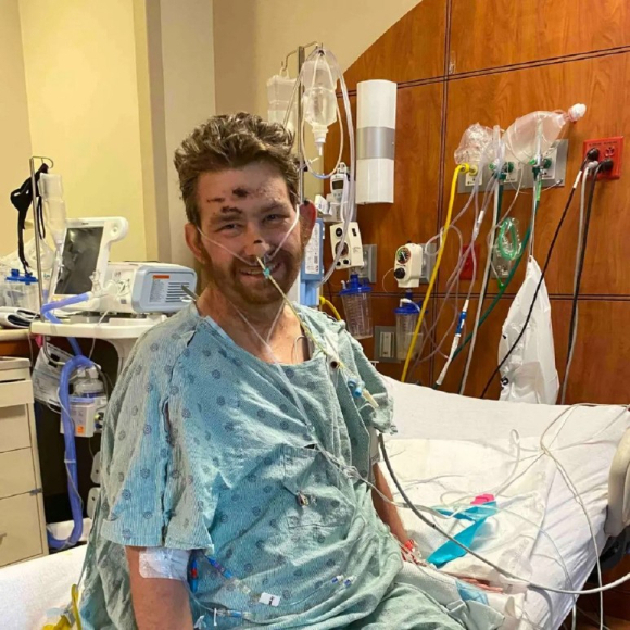 30대 후반 미국 남성 스티븐 스피날레는 사타구니에 생긴 인그로운 헤어를 무리하게 뽑다 패혈성 쇼크로 혼수상태에 빠졌으나, 여러 차례의 수술 후 기적적으로 의식을 되찾았다. [사진=데일리메일]