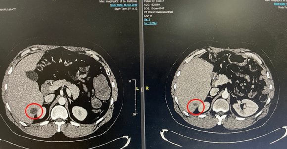 엔케이맥스가 슈퍼NK(SNK01)와 키트루다(Keytruda) 병용요법 치료 환자에게서 80% 관해를 확인했다고 23일 밝혔다. [사진=엔케이맥스]
