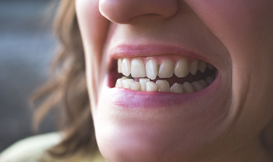 나이가 들면서 아래 앞니가 삐뚤어지는 이유에 대한 전문의의 설명이 나왔다. 사진은 본 기사 내용과 무관함. [사진=Smile Works Dental]