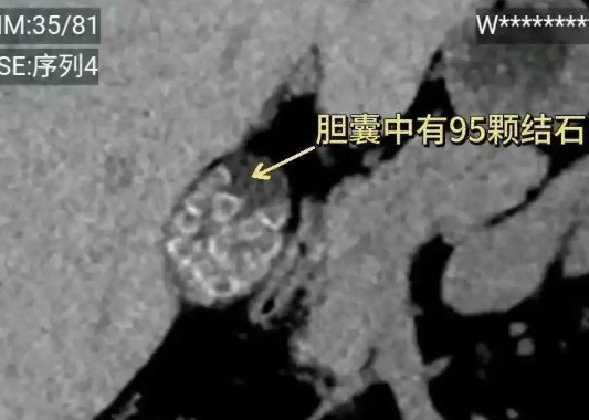 중국에서 10년 넘게 아침 식사를 거르고 야식을 즐긴 여성의 몸 안에 95개의 담석이 생긴 사례가 알려졌다. 사진은 챗GPT로 생성한 이미지. [사진=챗GPT]