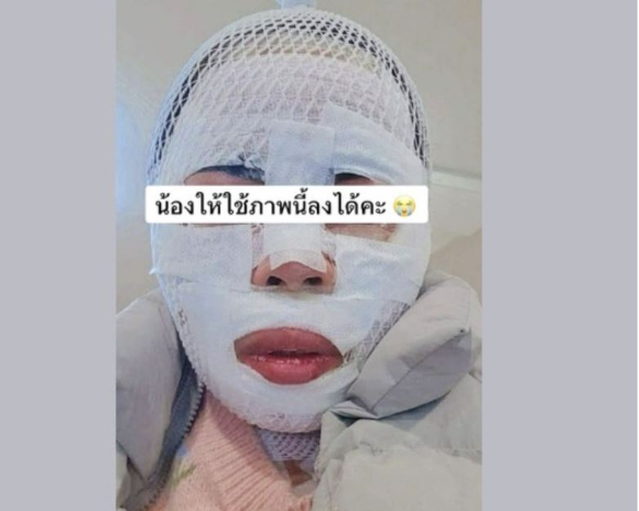 잠든 태국인 아내 얼굴에 끓는 물을 부어 중상을 입힌 한국인 남편이 검찰 구형량보다 높은 실형을 선고받았다. 사진은 피해 태국인 여성. [사진=페이스북]