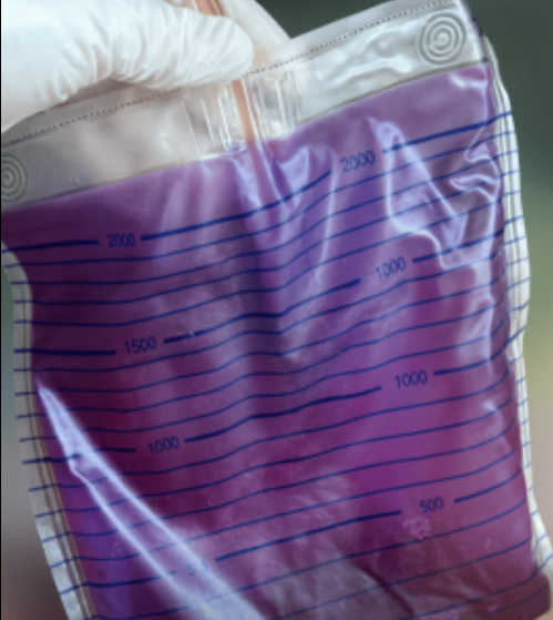 정상적으로 연한 황갈색을 띠는 소변이 80대 여성에게서 갑자기 보라색으로 변하는 드문 사례가 공개됐다. 사진은 본 기사 내용과 무관. [사진=atlanticurologyclinics]