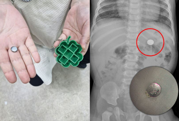 생후 9개월 된 영아가 장난감 속 건전지를 삼켜 230㎞ 떨어진 대학병원까지 이송돼 긴급 내시경 시술을 받는 일이 발생했다. 본 기사와 무관한 이미지. [사진=픽사베이@PublicDomainPictures]