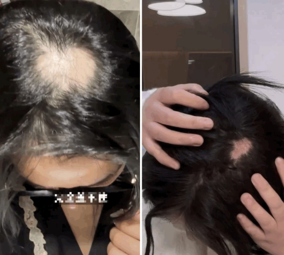 사진은 정수리 볼륨에 따른 얼굴형을 비교한 모습. [사진=페이스북 갈무리 ]