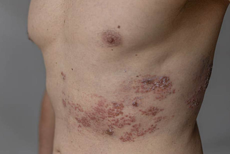 대상포진 환자 사례. [사진=픽사베이]