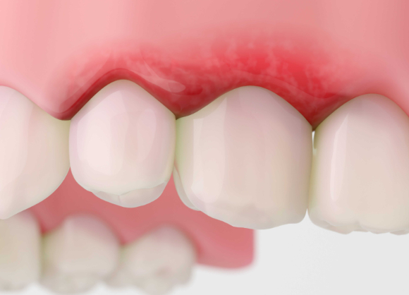 잇몸 건강을 해치는 생활 습관과 그 위험성이 전문의 설명을 통해 나왔다. 사진은 본 기사 내용과 무관. [사진=Oral-B]