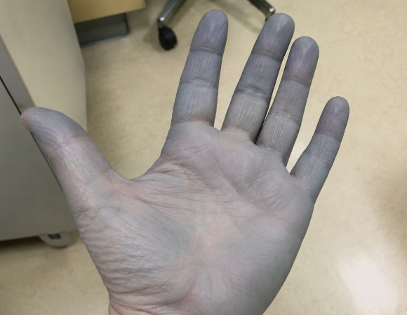 흔히 처방되는 항생제를 복용한 뒤 피부와 혀가 푸른빛으로 변한 여성 환자 사례가 국제 학술지에 보고됐다. 사진은 AI 생성 이미지로, 본 기사 내용과 무관. [사진=챗GPT]