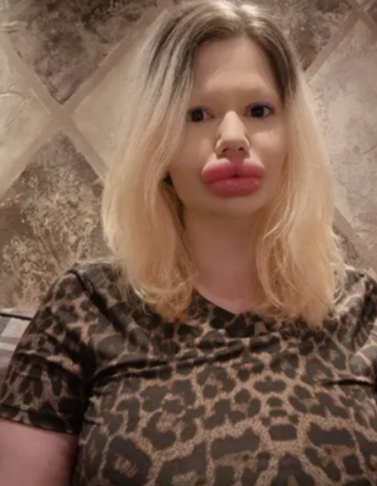 영국에서 입술 필러 시술에 약 2만 파운드(약 3800만원)를 들여 입술을 과도하게 부풀린 여성이 의료진에게 진료를 거부당한 사연이 알려졌다. 사진은 안드레아 이바노바. [사진=안드레아 이바노바 인스타그램 갈무리]