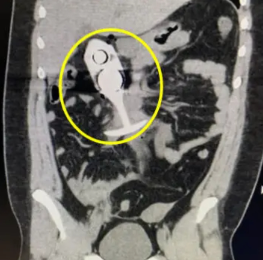 MRI(자기공명영상) 촬영 중 20대 여성이 몸 속에 삽입한 성인용품이 강력한 자기장에 반응해 심각한 사고로 이어졌다. 사진은 본 기사 내용과 무관. [사진=Singapore Heart Foundation]