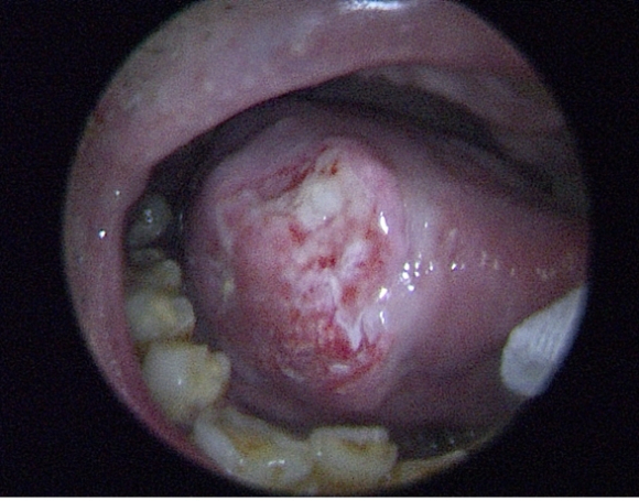 설암에 걸린 구강. [사진=한림대의료원]