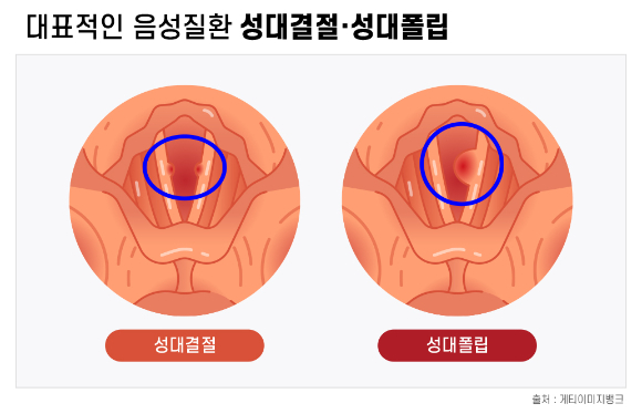 성대결절, 성대폴립 증상. [사진=강동경희대병원]
