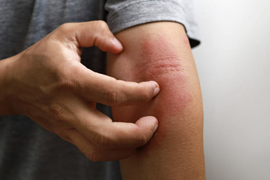 피부질환 관련 이미지. [사진=픽사베이]