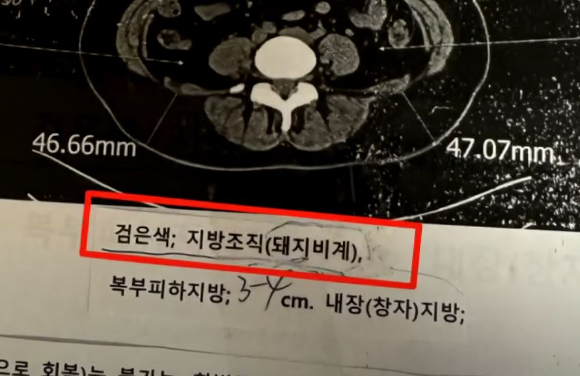 국내 한 병원에서 환자의 지방조직을 '돼지비계'라고 표현한 의사의 언행이 알려졌다. 사진은 여성 A씨가 국내 한 병원에서 촬영한 CT 검사 결과지. [사진=JTBC  사건반장 캡처]