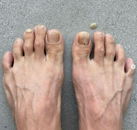 가수 션이 발톱이 빠진 발을 공개했다. [사진=션 인스타그램]