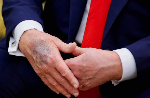 지난 25일(현지시간) 백악관에서 이재명 대통령과 악수하는 도널드 트럼프 미국 대통령(왼쪽)의 오른손 손등에 멍으로 보이는 검푸른 자국이 포착됐다. [사진=AP/연합뉴스]